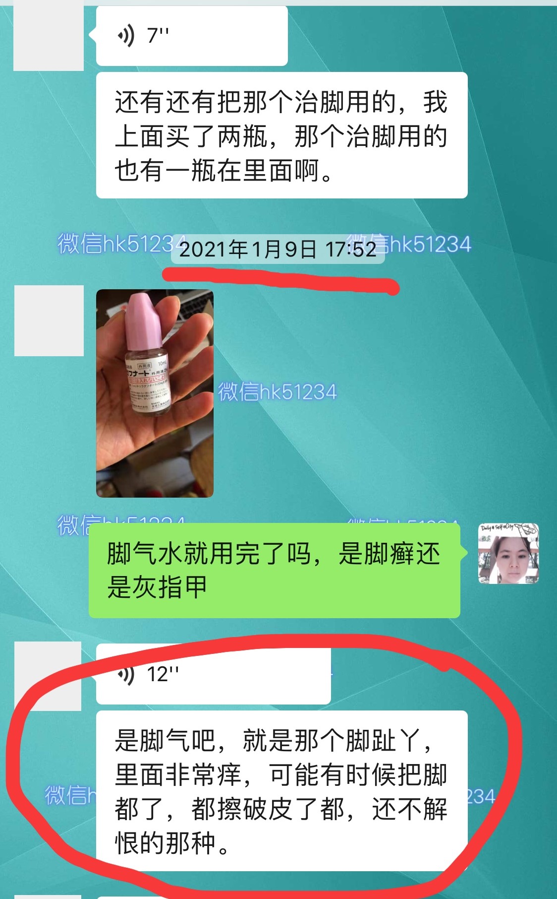 脚气烂脚趾缝痒溃烂怎么治