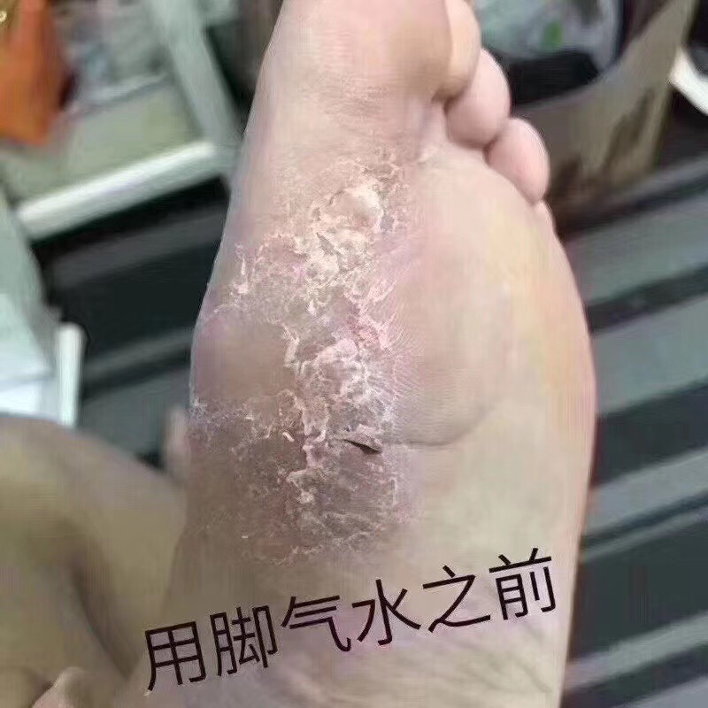 脚气真菌感染用什么药最好