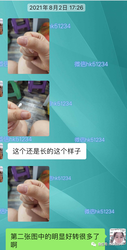 灰指甲用什么药最有效最好能根治