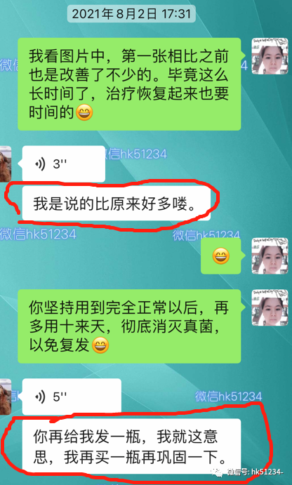 灰指甲怎么才能根治